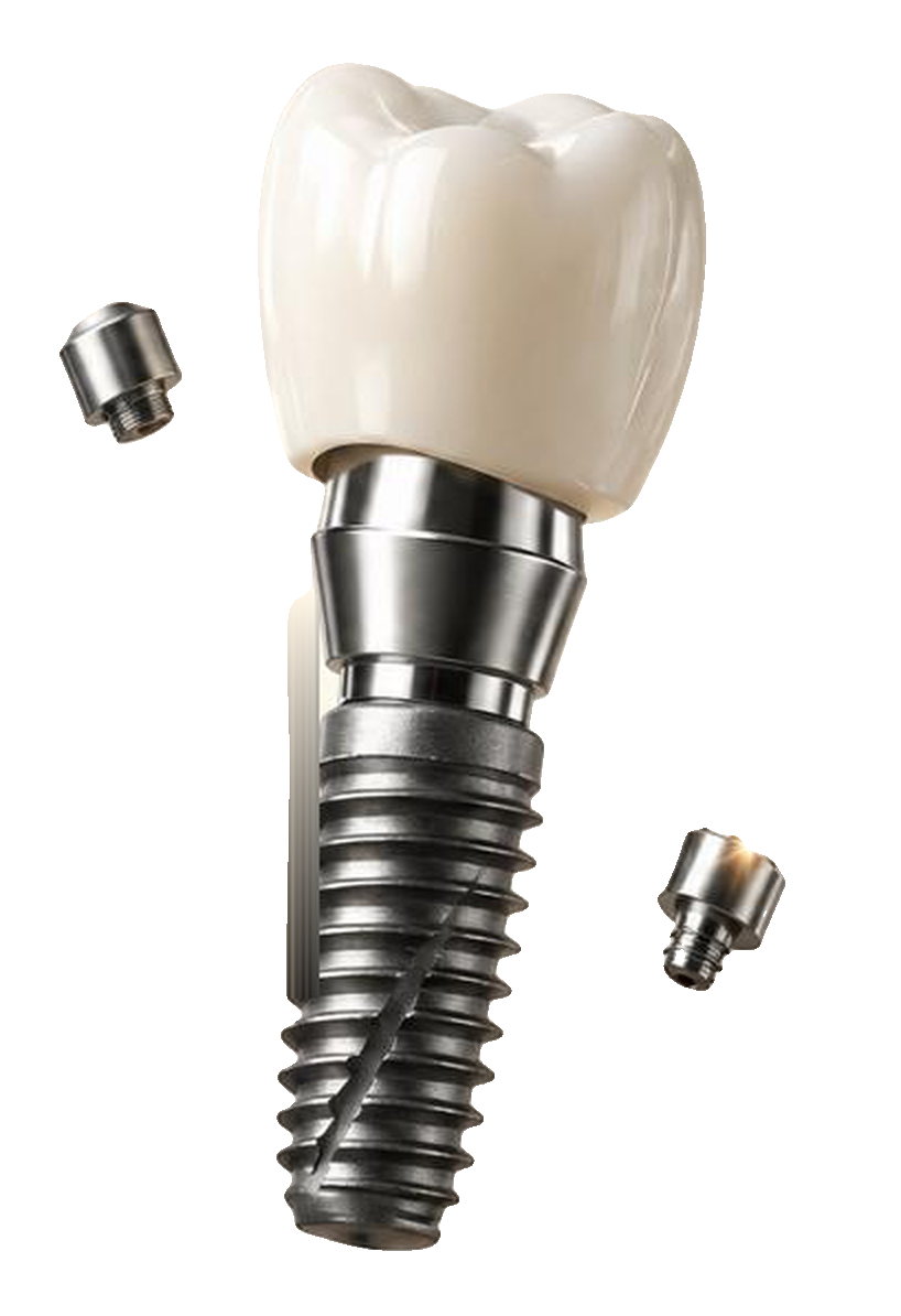 Zahnimplantat mit Keramikkrone und Abutments
